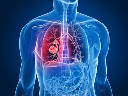 Treatment of lung cancer in Germany